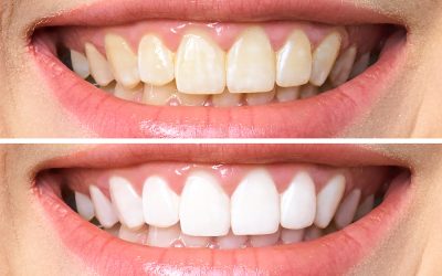 6 Foods and Drinks that are Staining Your Teeth