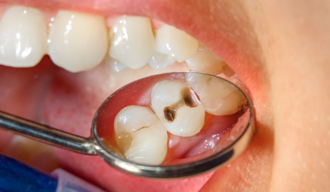 Some Simple Things You Can Do To Prevent Cavities