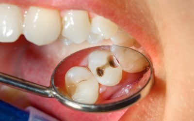 Some Simple Things You Can Do To Prevent Cavities
